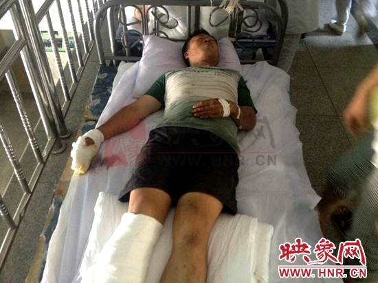 張國(guó)建右手及腿部多處燒傷 張國(guó)建右手及腿部多處燒傷