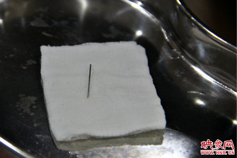 上午11點30分許，小龍腦中鋼針已經(jīng)成功取出。