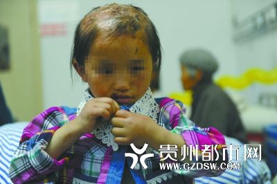 被燙傷的頭皮一直沒(méi)有愈合。