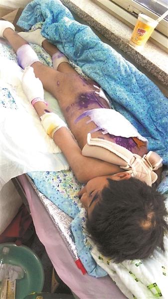 女童遭“國學(xué)老師”虐打致多處骨折 被罰吃廁紙 女童遭“國學(xué)老師”虐打致多處骨折 被罰吃廁紙