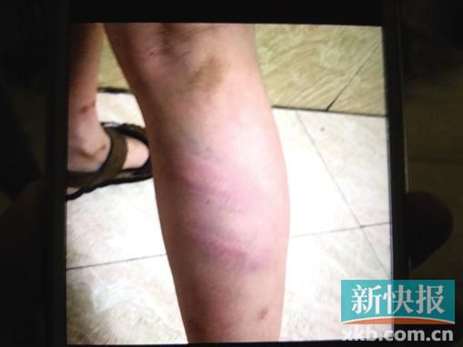 小宇腿部有明顯瘀痕。 翻拍自家屬手機