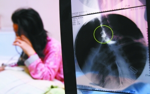 假牙上的鋼絲刺破食管，而薄薄的食道壁緊貼主動(dòng)脈血管，極易造成血管破裂