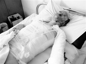 周小姐的頭、頸、軀干、四肢均被燒傷，其中面部燒傷最為嚴(yán)重。