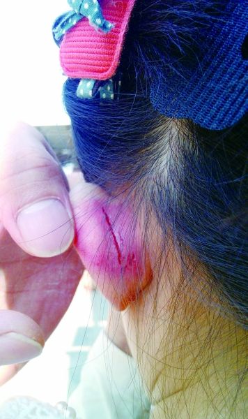 　　女童的耳朵被老師揪裂。圖片由女童家人提供