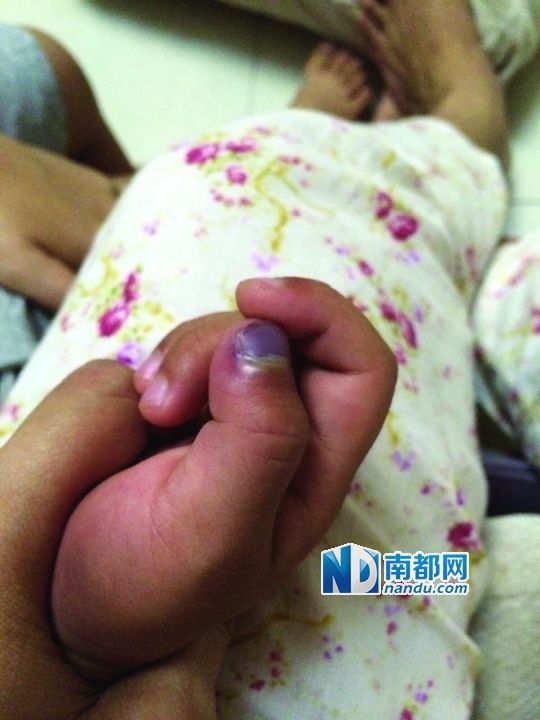 小逸手指被夾傷。