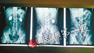 ▲片子上能看見(jiàn)巨大結(jié)石 ▲片子上能看見(jiàn)巨大結(jié)石