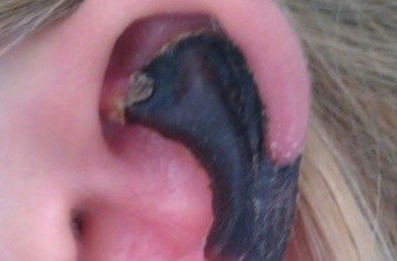 荷蘭女子旅游途中被蜘蛛咬，耳軟骨溶解變黑。