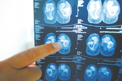 X光片顯示,確實(shí)有一根殘留的螺絲釘。