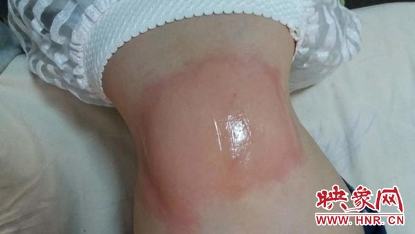 緯三路小學一名學生身上出現(xiàn)的不適癥狀 緯三路小學一名學生身上出現(xiàn)的不適癥狀