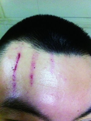 　2013年，被打者受傷照