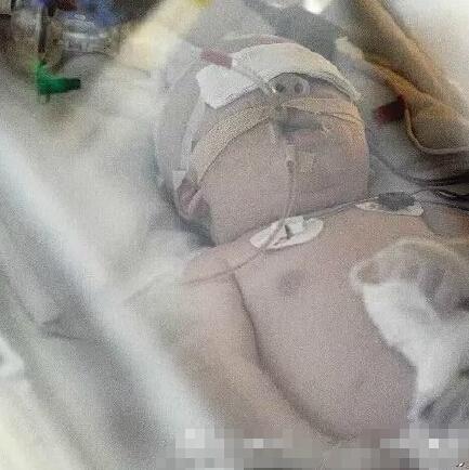 感染嬰兒 感染嬰兒