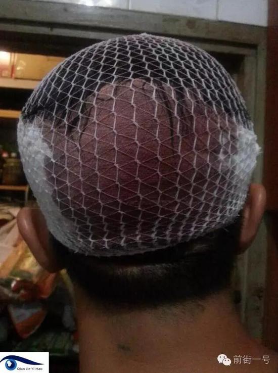 李律師受傷后縫合三針。