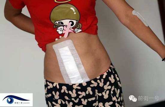 小金腹部的傷口。