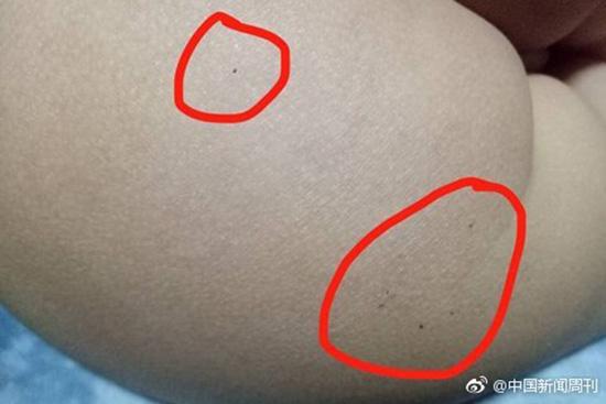 據(jù)多名紅黃藍(新天地分園)家長反映，孩子腿部、屁股、腋下出現(xiàn)針眼。