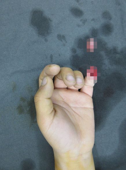 嚇哭！6歲男孩被夾斷手指 罪魁禍?zhǔn)拙故切７? oldsrc=