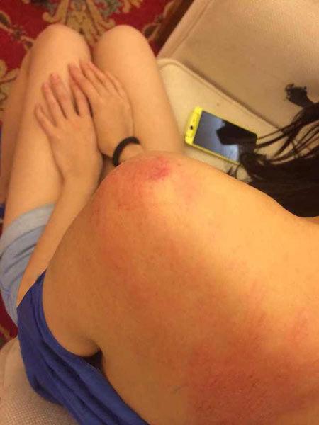 “跑男”真的很拼！baby朋友圈曬后背紅腫照