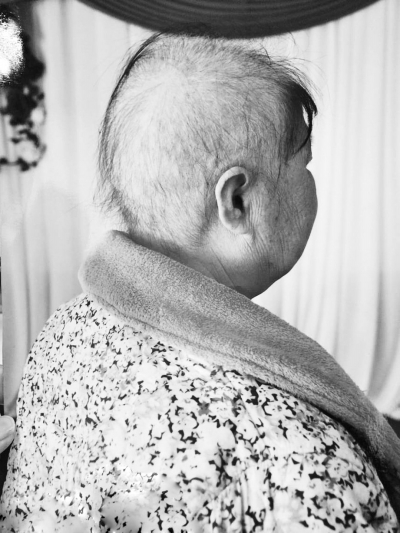 化療之后張?zhí)m大面積掉發(fā) 化療之后張?zhí)m大面積掉發(fā)