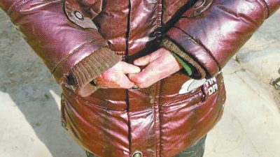 長期受損的手指，已經(jīng)長在了一起。