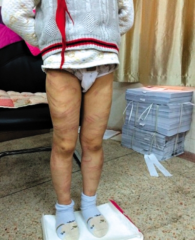 4月3日晚，微博網(wǎng)友“@朝廷半日閑”發(fā)圖文微博展示男童被虐待的慘狀。 微博截圖