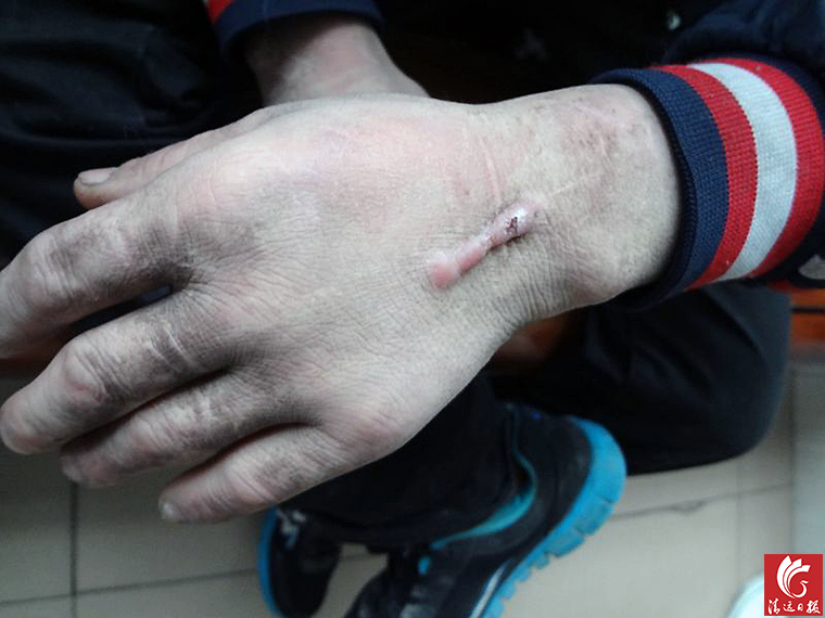 被發(fā)現(xiàn)男子手上的傷疤。