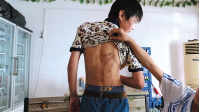 　昨日，奶西村，被打的小剛后背上條條瘀痕依然明顯。