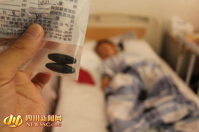 四川女童誤吞磁性小球42天后被取出 腸壁壞死 四川女童誤吞磁性小球42天后被取出 腸壁壞死
