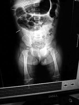 目前體內(nèi)的12根鋼針多分布在孩子的臀部，一根在腹部，其余3根在胸腔附近，其中一根很接近心臟