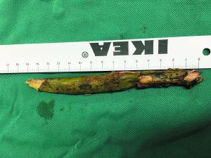 插入男子腦內(nèi)的樹枝。