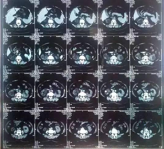 55歲大爺因愛(ài)吃豆腐 體內(nèi)取出420顆結(jié)石