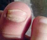 一幼兒園兒童“指甲異?！? title=